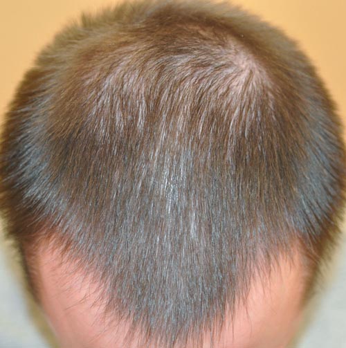 Результат лечения волос в Центре здоровья волос