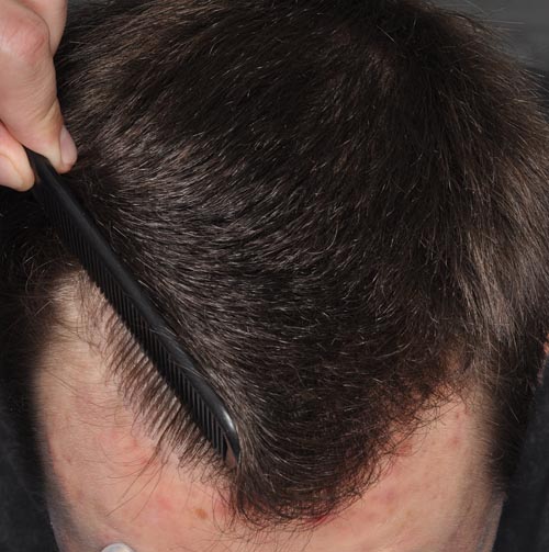 Результат пересадки волос в Центре здоровья волос